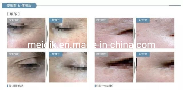 Factory Price Korean Pcl Collagen Injection Pubertype Essence Pcl Polylactic Acid Injection for Wrinkles Removal Eye Area Face Volume Baby Face More Younger