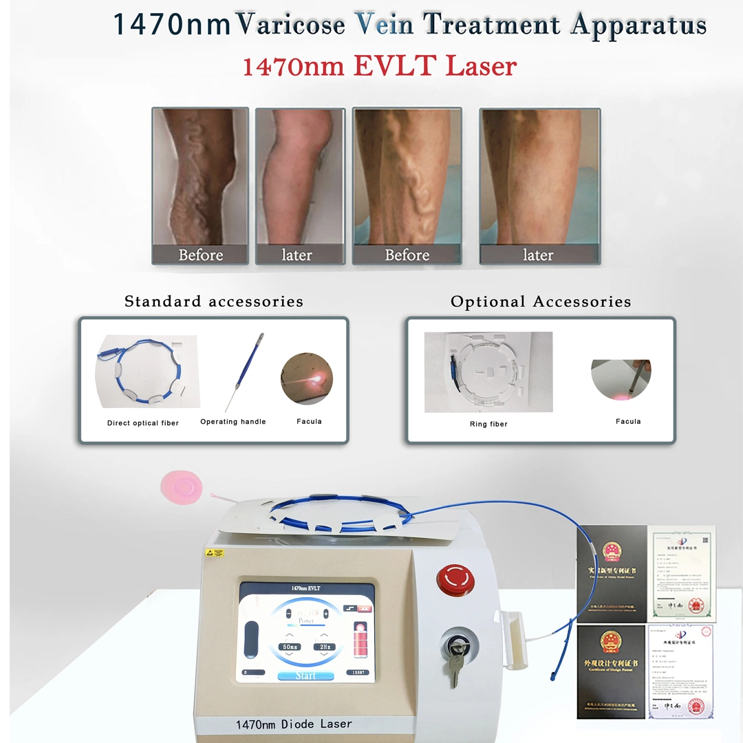 جهاز Veins محمول بتقنية الليزر بتقنية Evlt، بتقنية Varicose 1470nm