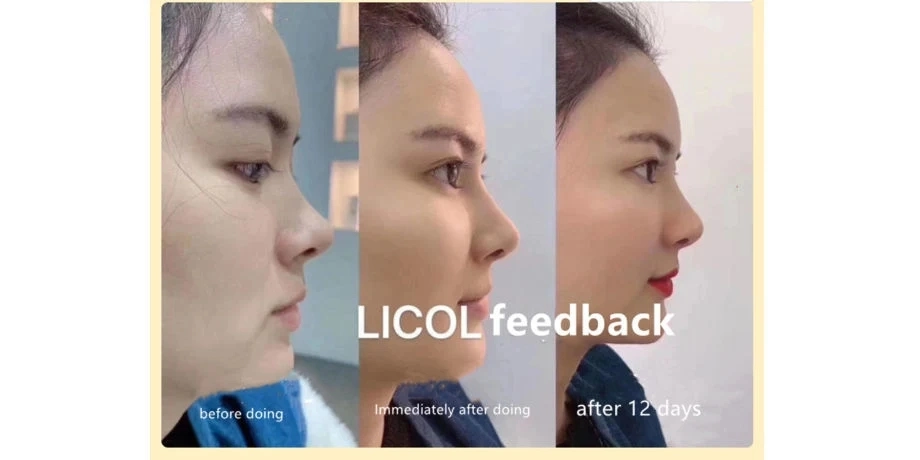 Korea Dermal Filler Dextran Licol Gold Hard for Shape The Nose Long Lasting Composed of 10% PMMA and 90% Glucan