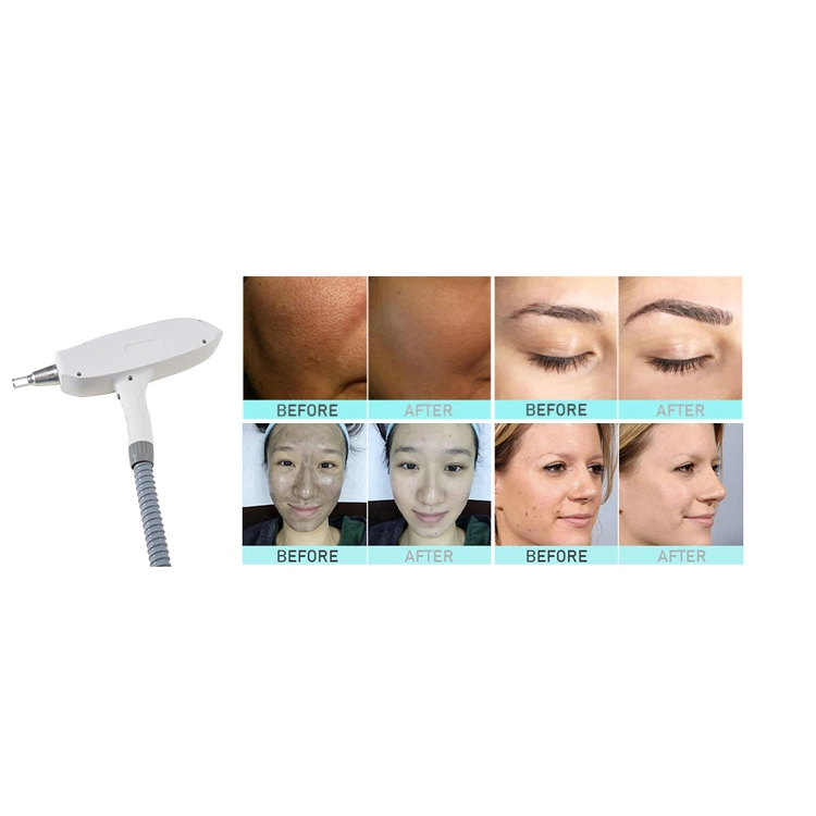 4 em 1 Máquina de beleza RF laser 808nm + Laser de diodo laser YAG ND de remoção de tatuagens + Remoção de pêlos Dpl