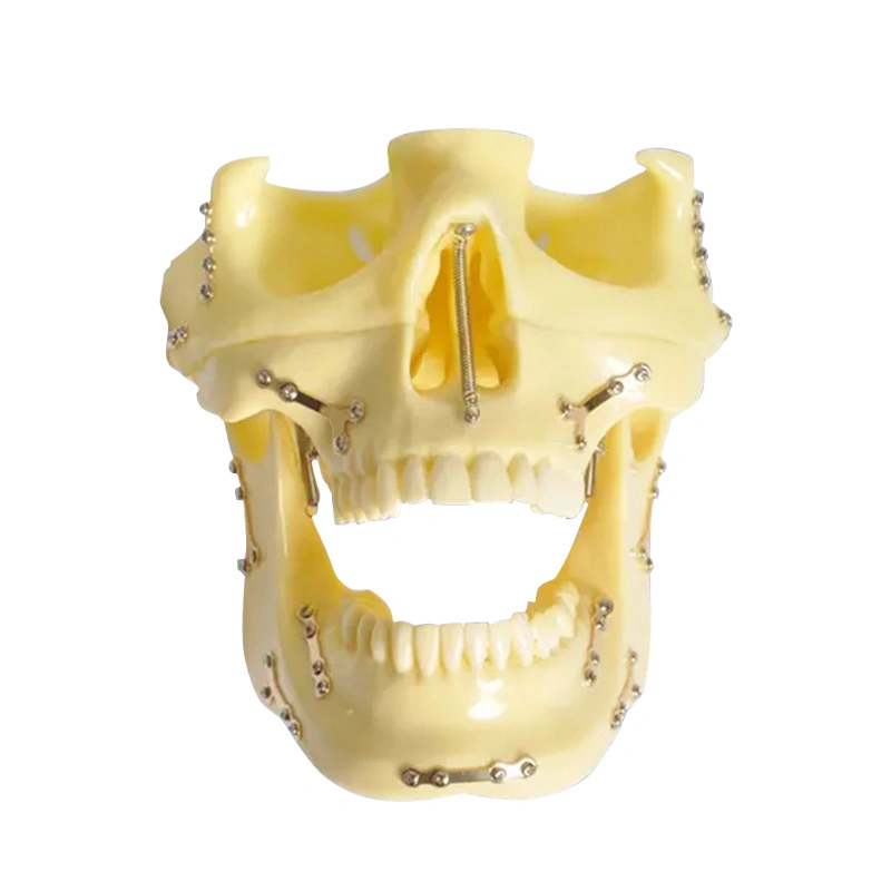 Fixed Bone Fracture with Titanium Plate and Ortho Implant Dental Skull Model