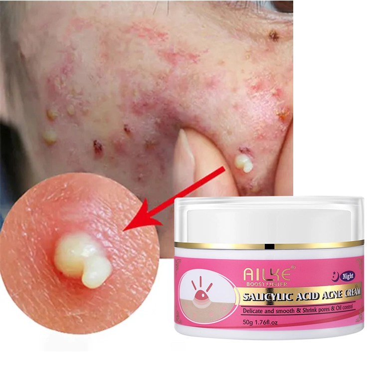 Natural Salicylic Acid Oil Control Moisturizing Acne Removal Face Cream Anti Acne Cream for Oily Skin