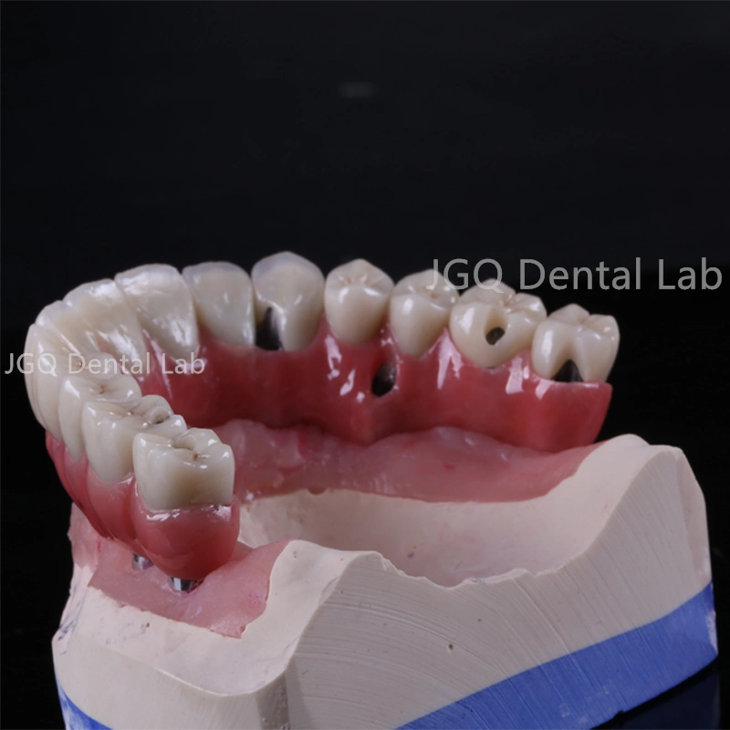 Dental Implant Supplies All-on-6 Full Contour Zirconia Upper Dental Implant Bridge