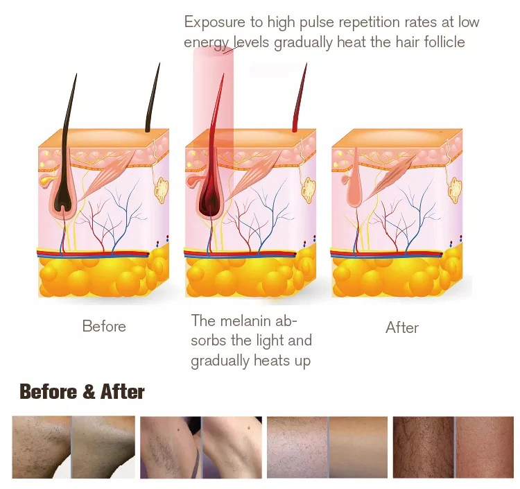 OEM IPL PhotoRejuvenecimiento Opt elight piel Photo Rejuvenation Ice Laser Terapia de eliminación del cabello elight Opt IPL máquina de eliminación del cabello