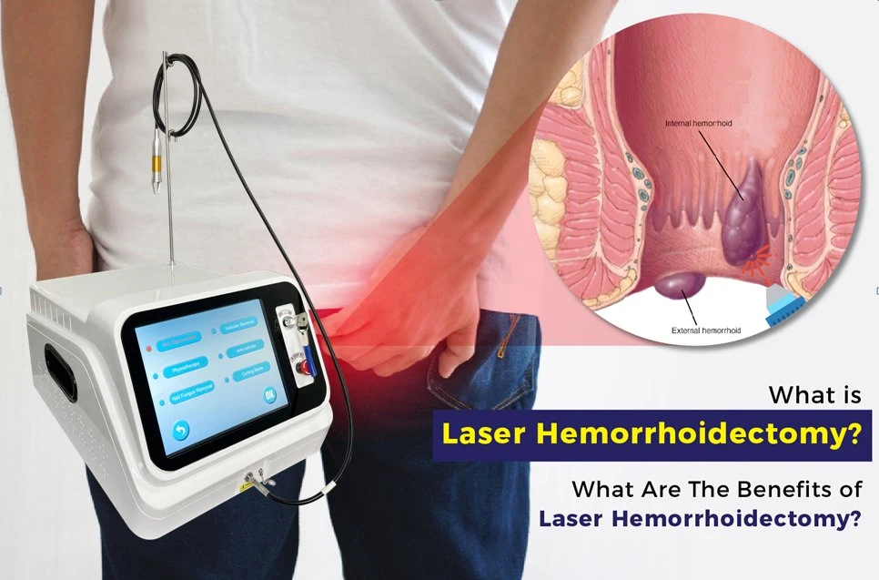 Dual-Wellenlänge Lipolyse Entolift Laser-Ausrüstung Liposuktion Maschine Chirurgie Diode Laser 980 1470 Nm für Hemorrhoid