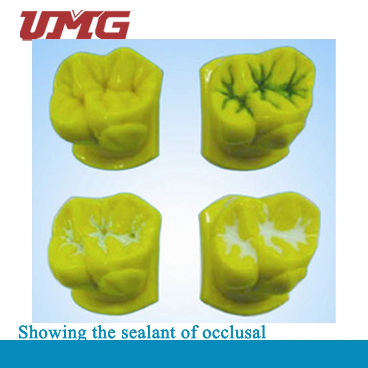 Dental Model Showing The Sealant of Occlusal