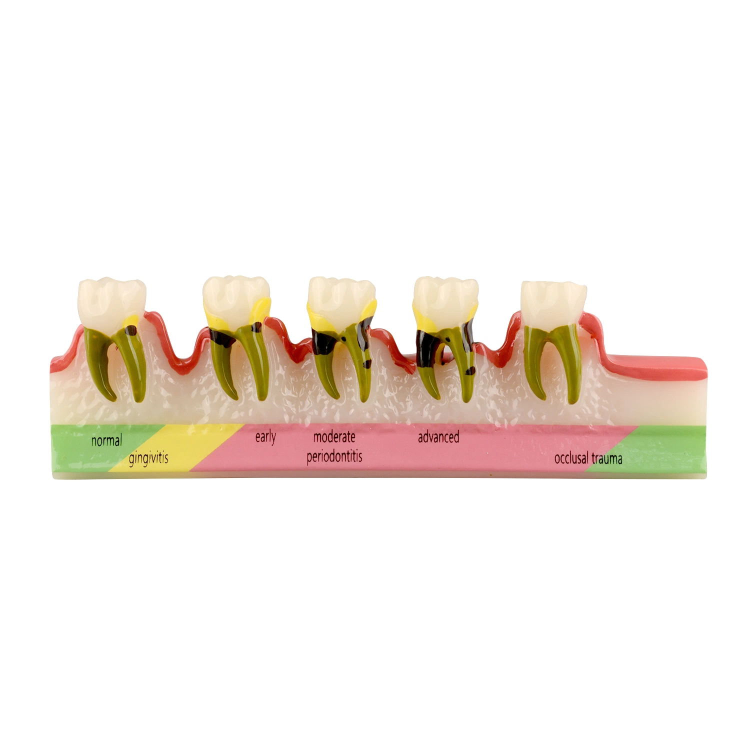 Dental Periodontal Disease Assort Model