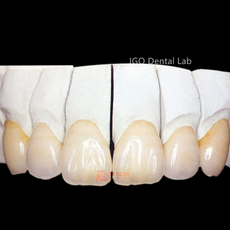 Dentures Teeth Metal Porcelain Ceramic Implant Pfm Crowns and Bridge From China Dental Lab