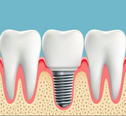 Wego CE SLA Microdual Tread Dental Implant Tooth Implant