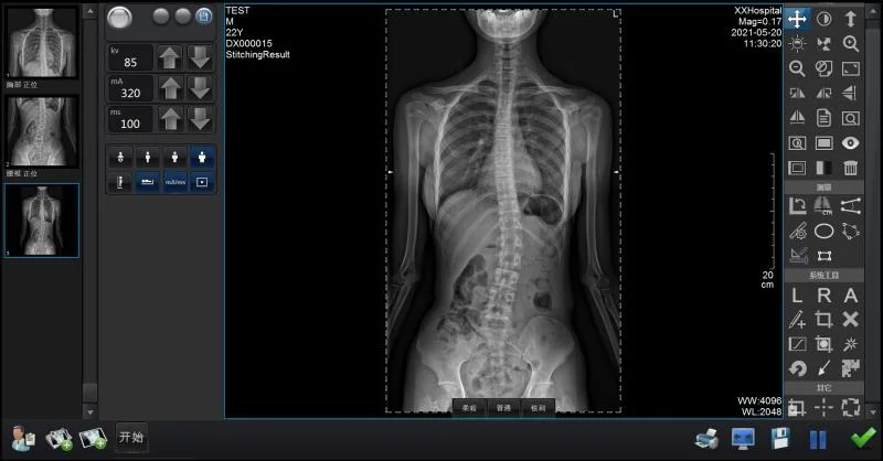 Digitaler drahtloser Flachdetektor mit Software und Röntgenstrahlung Maschine Iray Mars 1417V Preis DR Cr System Radiologie Ausrüstung Und Zubehör