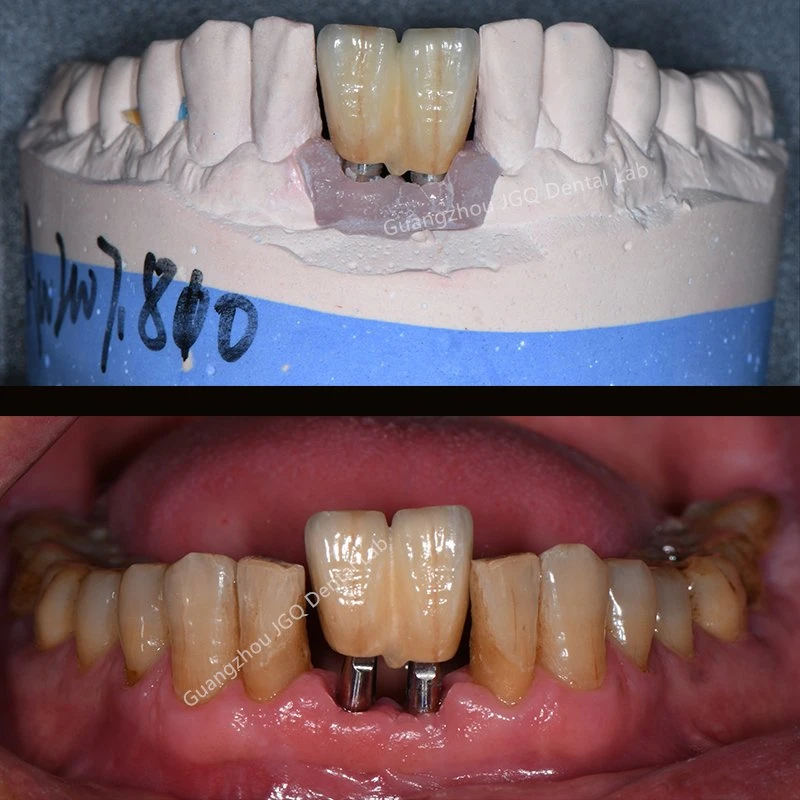 Fournitures de matériaux dentaires came dentaire tous les matériaux céramique implant couronne fait En laboratoire dentaire de Chine