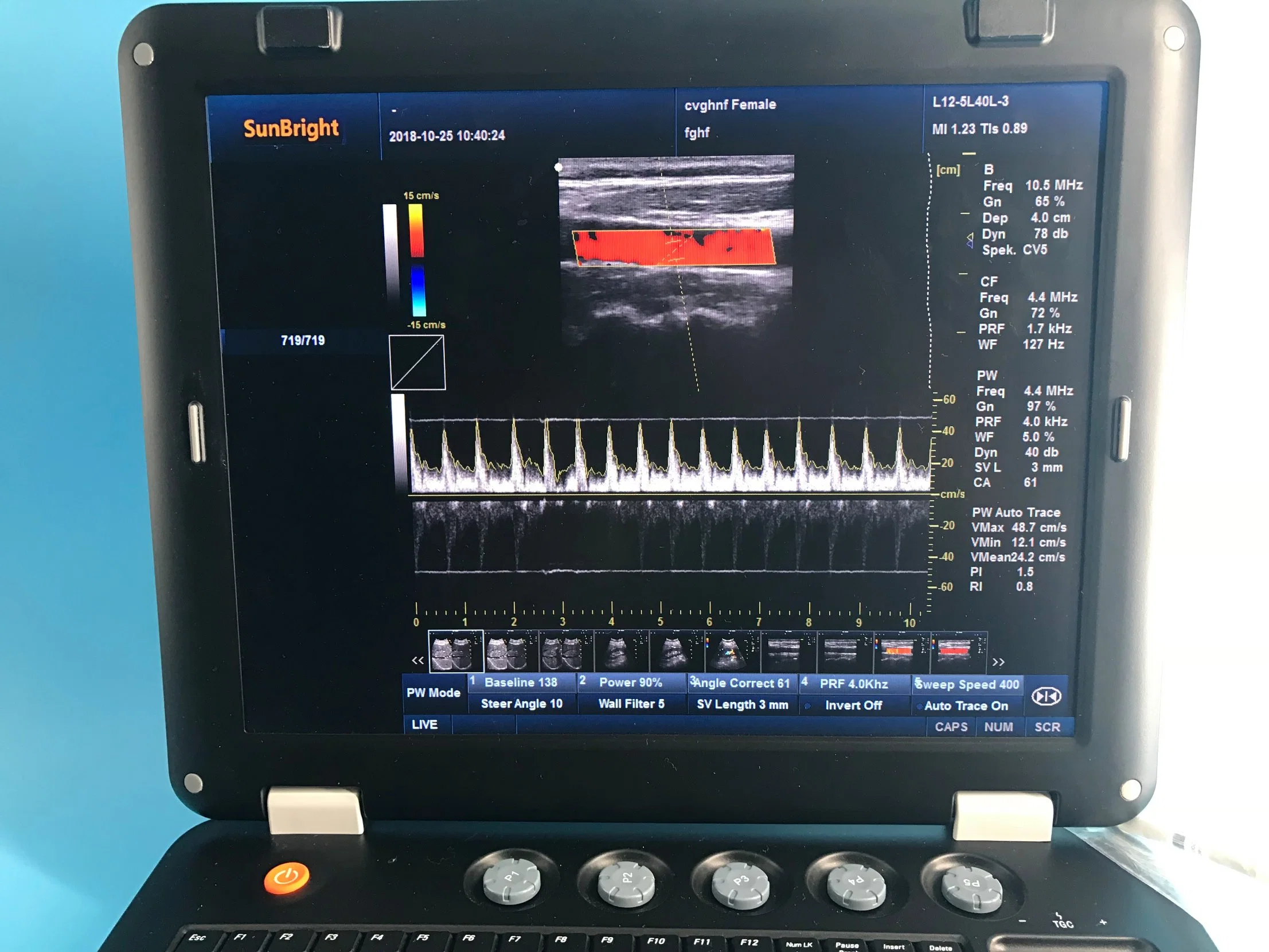 El ultrasonido Doppler para bloqueo del nervio de alta frecuencia Lineal Color Pw Aparato médico