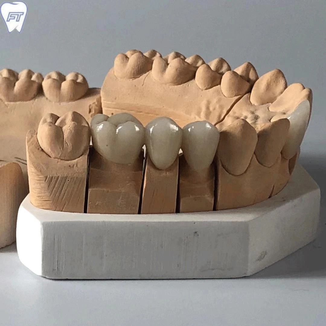 Matériel dentaire laboratoire laboratoire dentaire Implant Bruxzir personnalisé couronnes et de zirconium pont solide de la Chine Dental Lab