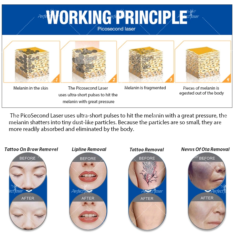 أفضل إزالة تاتو الليزر Pico إزالة البشرة تجديد البشرة 532 نانومتر 755 نانومتر 1064 نانومتر واستوردت كوريا التي يبلغ طولها 1320 نانومتر 7 وصلات ليزر عالية الفعالية