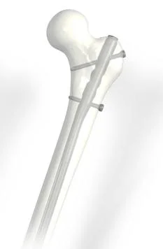 O Intertravamento esmalte de unhas de fêmur de implantes ortopédicos