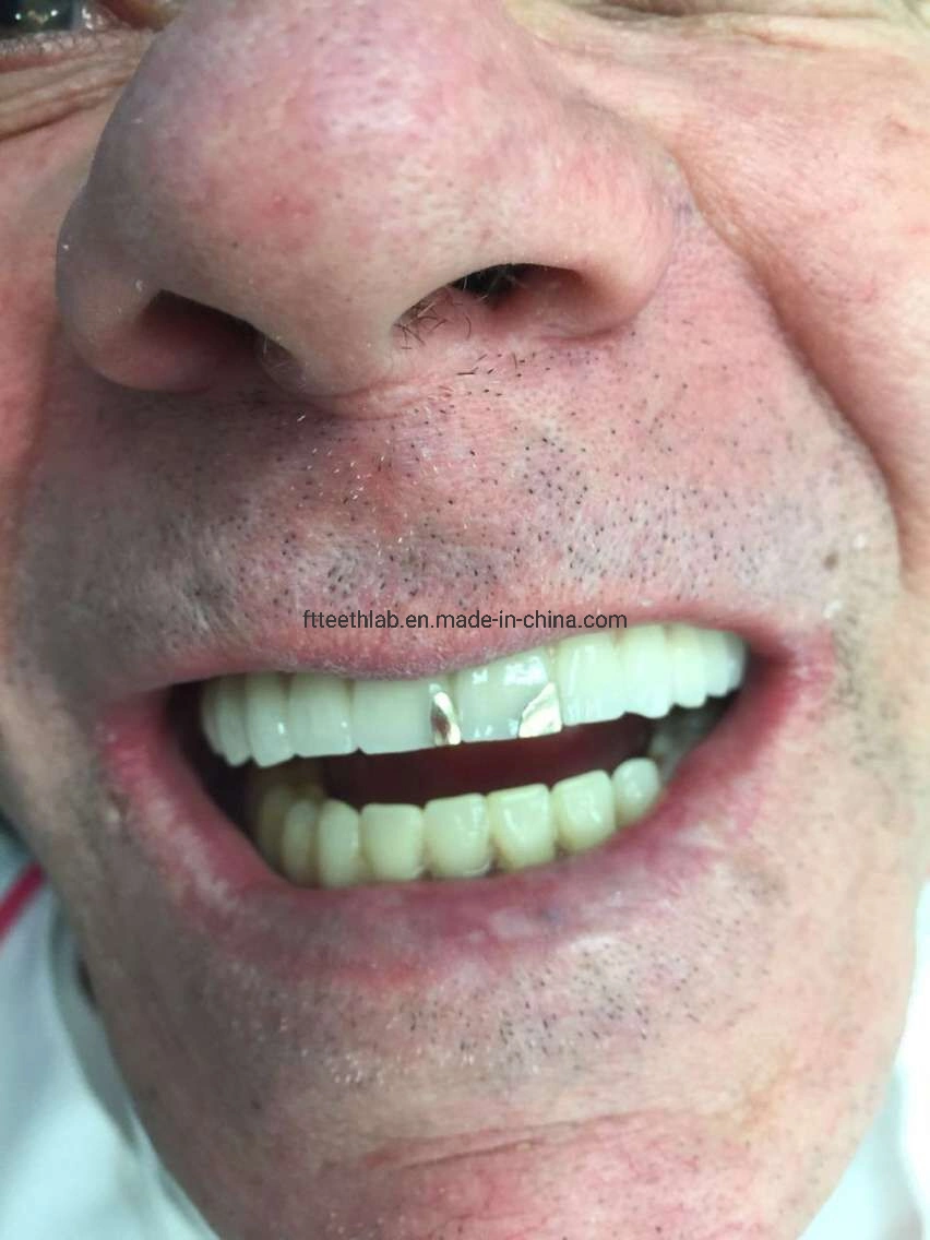 Full Arch Fixed Dental Implant Bridge for Mouth Rehabilitation