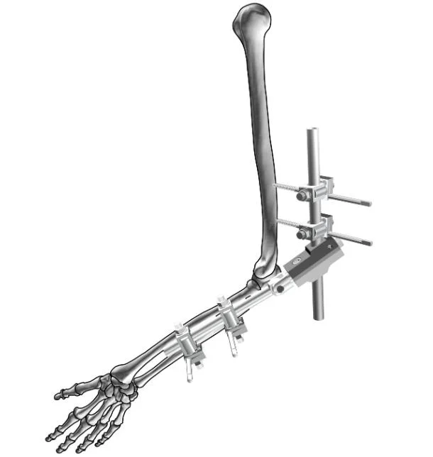 Fixation externe Orthopédie du système de fixation éternelle de cadre de Backbone Radius