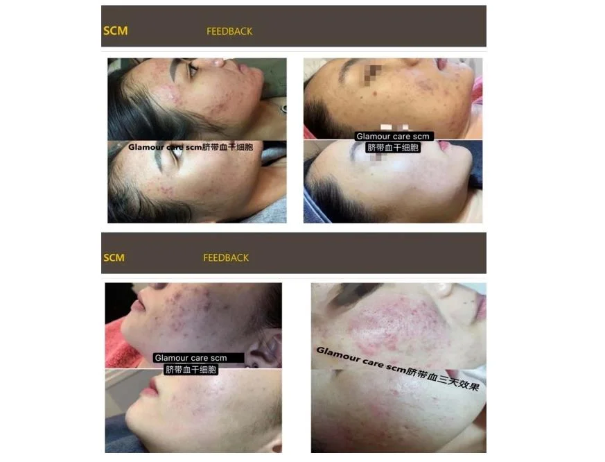 Scm Korea Human Stem Cell Continuously Stimulate Collagen Hyperplasia/Improve Skin Quality/Refresh Facial Skin Cells