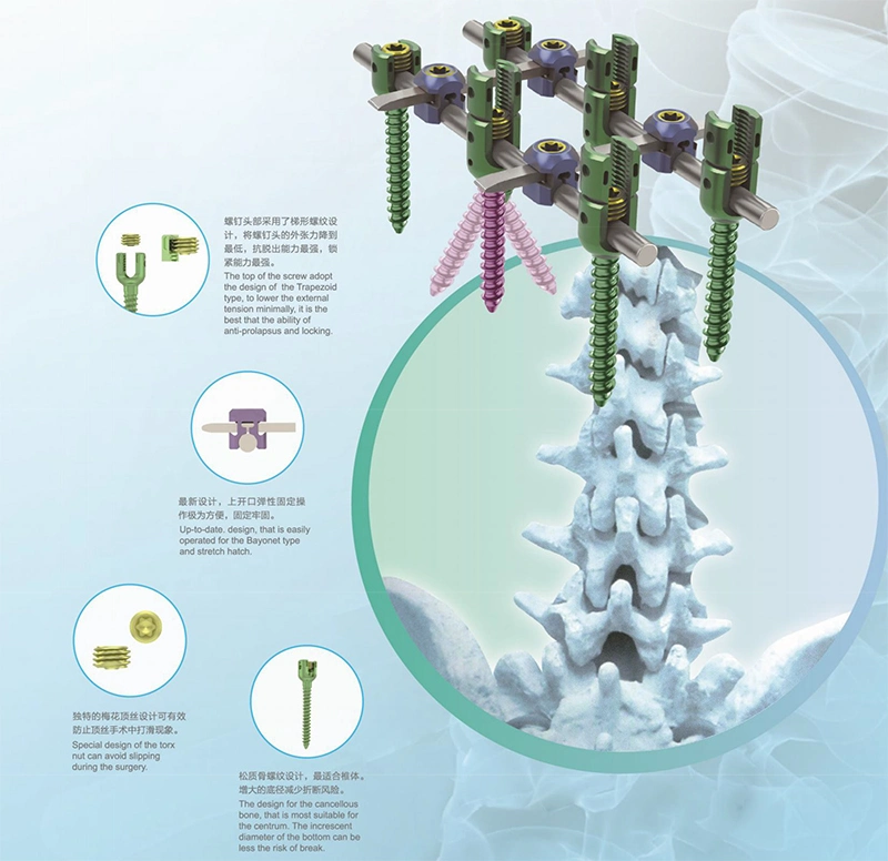 Spinal Orthopedic Trauma Implants Breakable/Monoaxial Pedicle Screws