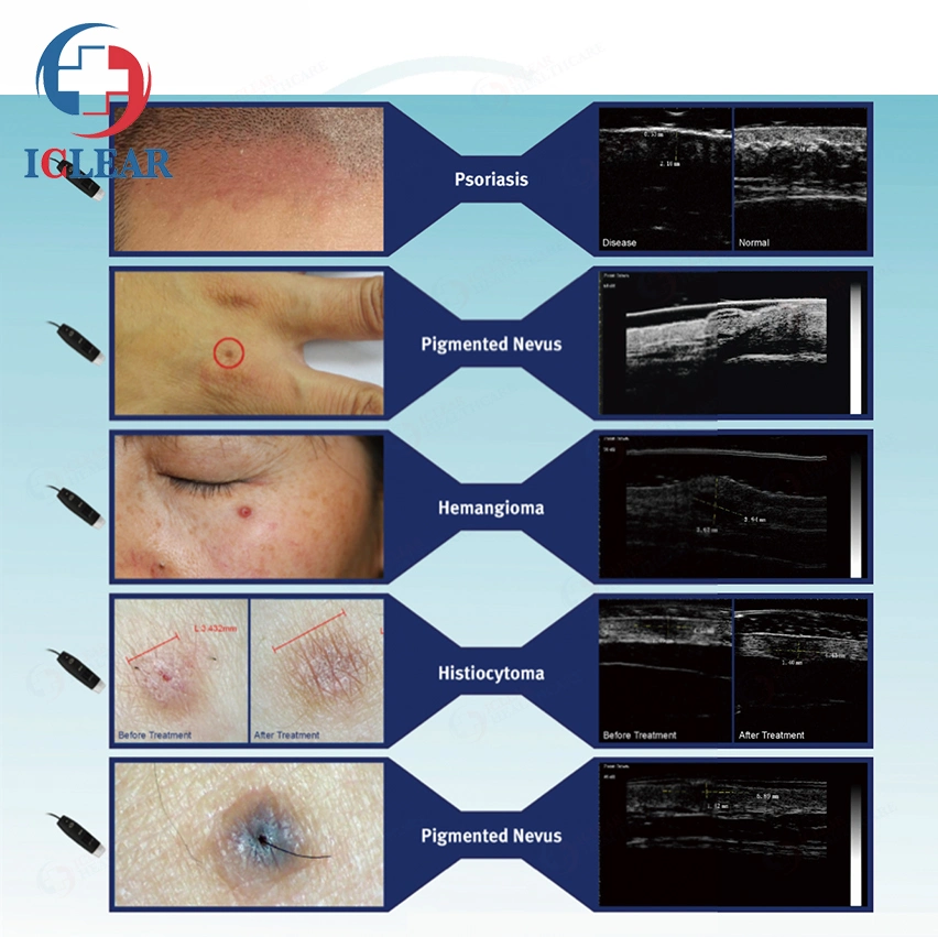 50um B &amp; B+a Dermatología no invasiva de diagnóstico por ultrasonidos Analizador de piel