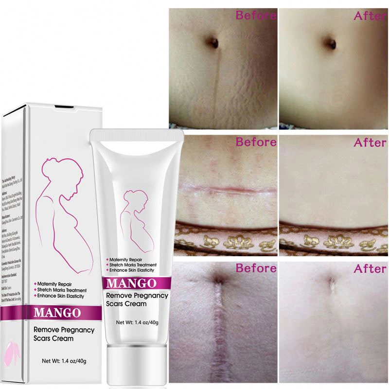 Customized Label Schwangerschaft Anti-Stretch-Mark Entfernung Reparatur Creme Best Natural