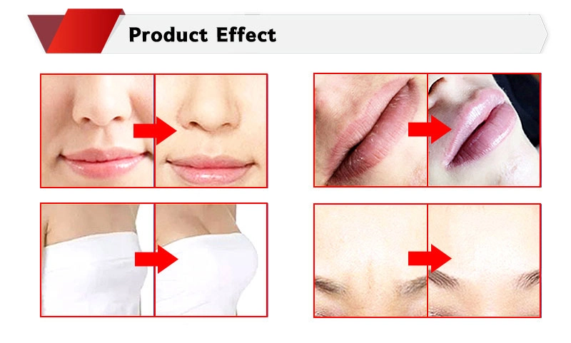 High Effect 5ml Ha Dermal Filler for Forehead