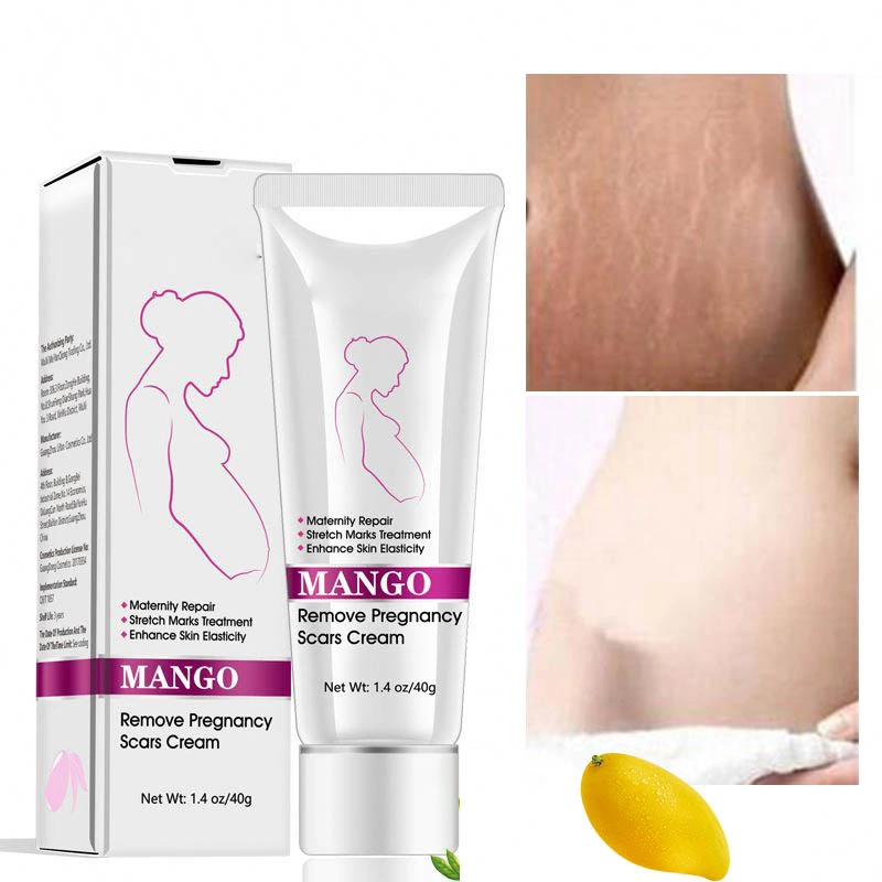 Customized Label Schwangerschaft Anti-Stretch-Mark Entfernung Reparatur Creme Best Natural