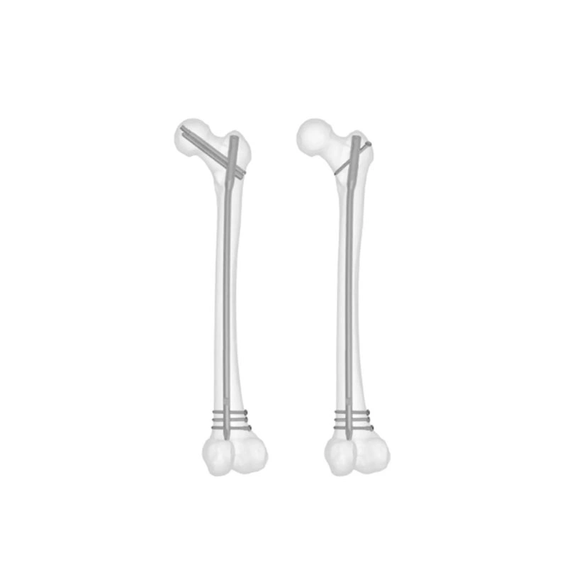 Titanium Intramedullary Nail Intertan Orthopedic Implants with CE&ISO