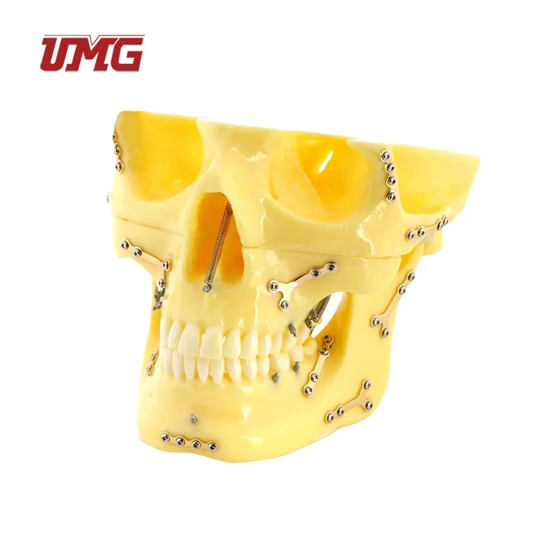 Fixed Bone Fracture with Titanium Plate and Ortho Implant Dental Skull Model