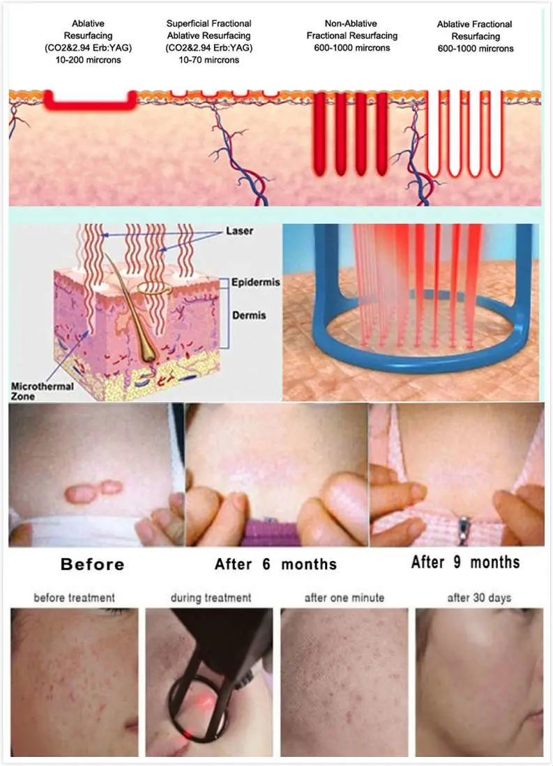 2023 Promotion Surgical Laser Scars Removal Vaginal Tightening&Rejuvenation RF Fractional CO2 Laser for CO2 Acne Scar Treatment