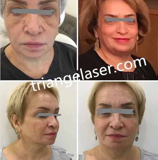 A lipoaspiração lipólise 980nm 810nm 1470nm Sistema Laser perda de gordura Power