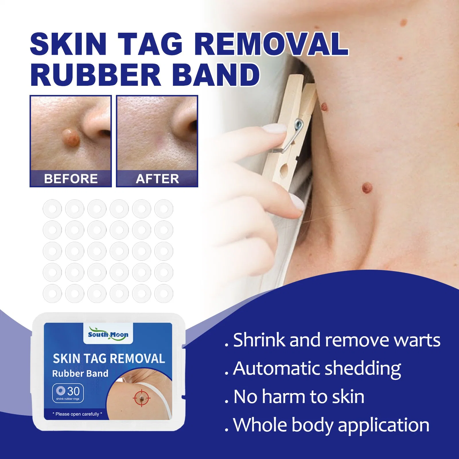 Skin Tag Remover Band Mole Wart Acne Pimple Patch Removal Spot