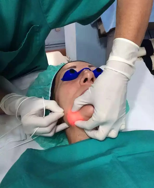 Máquinas de sucção laser profissional de 980 nm e 1470 nm, equipamento de elevação de superfície de Lipoaspiração cirúrgica