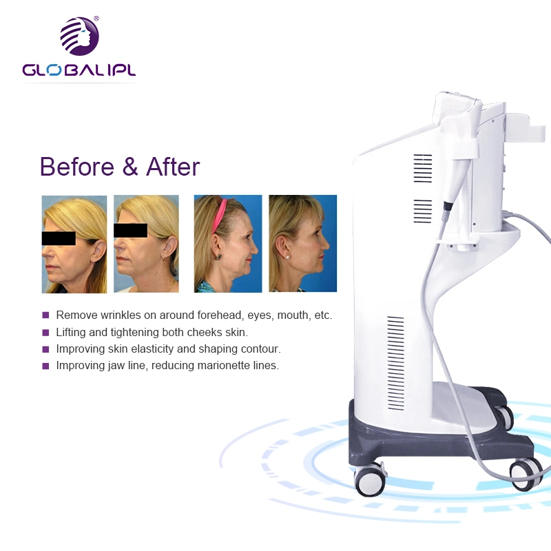 3D Hifu Ultrasonido de Alta Intensidad equipos médicos para eliminar las arrugas más cuidado de piel