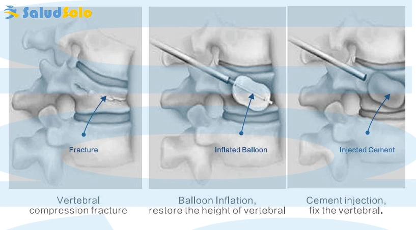 Kyphoplastia balão bomba de inflação PKP instrumentos cirúrgicos sistema de coluna dispositivo de enchimento de balão, CE e ISO