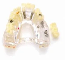 Implant Model for Showing Implant and Restoration Caries