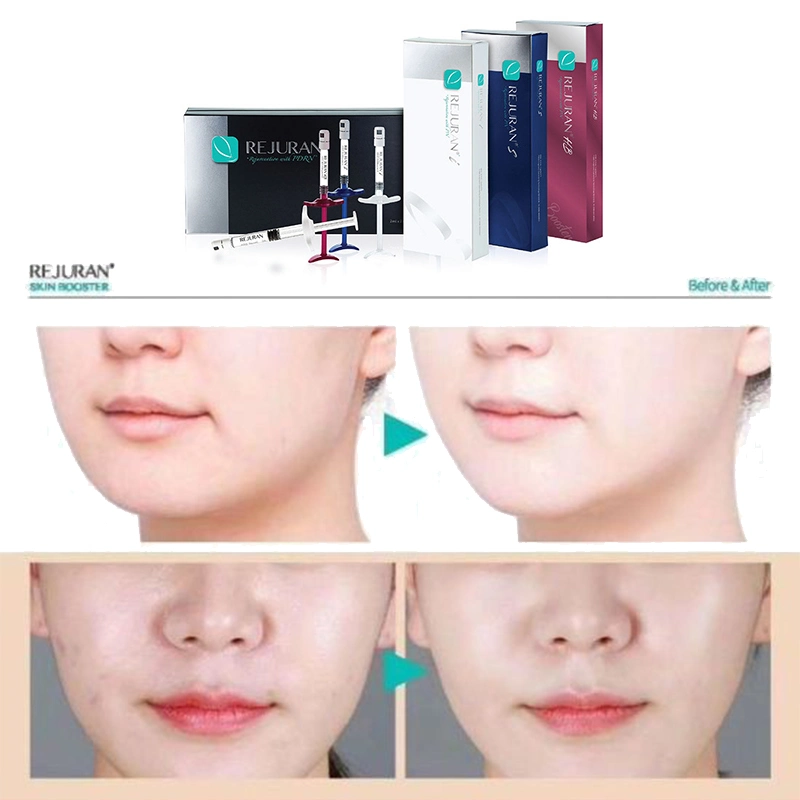 Rejuran Healer der niedrigste Preis in der Geschichte. Korea Dermal Filler Lachs DNA Prrn Therapie Wunderheilmittel Injektion