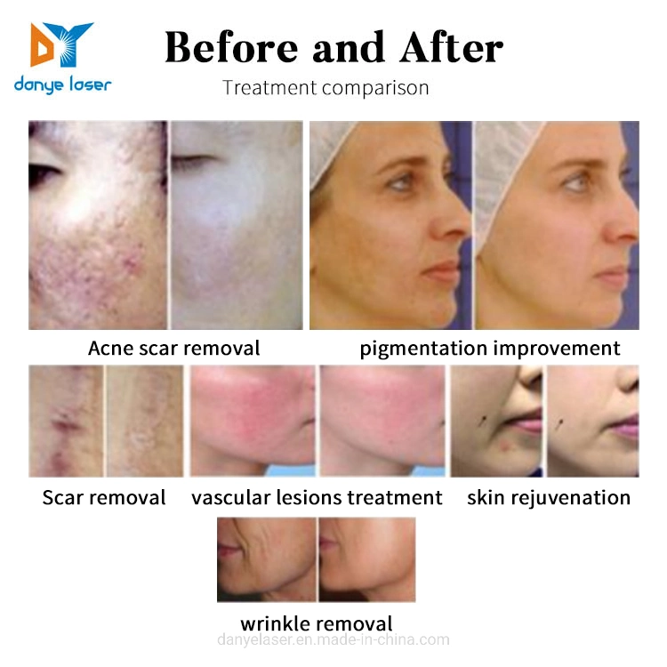 CE Approved CO2 Fraccional Laser for Medical Use Skin Resurfacing Scar Treatment Laser CO2 (beauty)