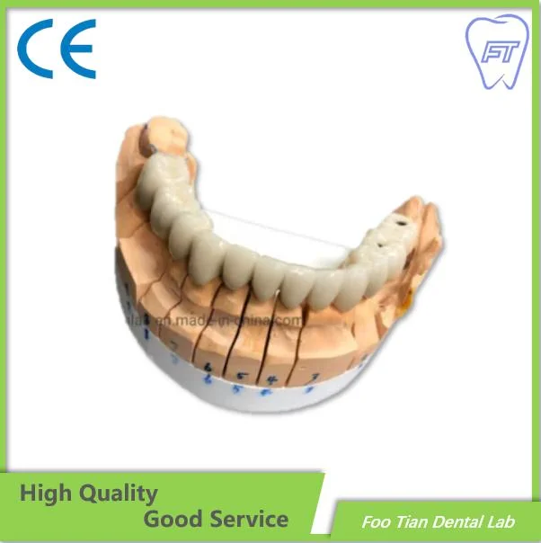 L'Orthodontie Traitement dentaire couronne en céramique de métal faites dans foo Tian Dental Lab à Shenzhen en Chine