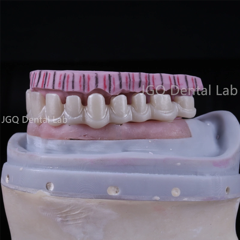Dental Products Vollbogen Zirconium Implant Bridge mit verschraubtem Titan Implantat
