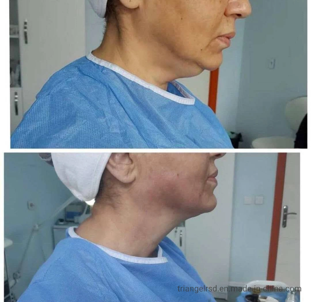 Remoção de gordura corpo Máquina de calagem 980 nm 1470 nm Díodo laser lipólise VASER Liposuction Fiberlift Laser lipoma Removal Beleza Machine