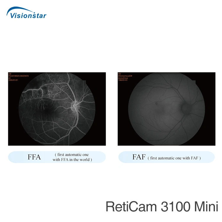 Reticam 3100 (модель B) дна матки пациентки флюоресценция ангиографии дна матки пациентки камеры и ФФА