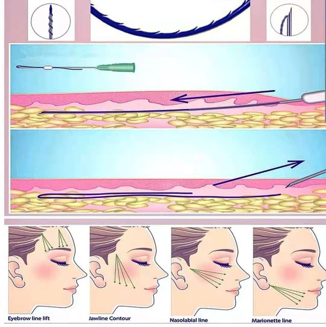 Elevación de cejas Facial Cog tipo L Aguja sutura absorbible Pdo de la cirugía las roscas