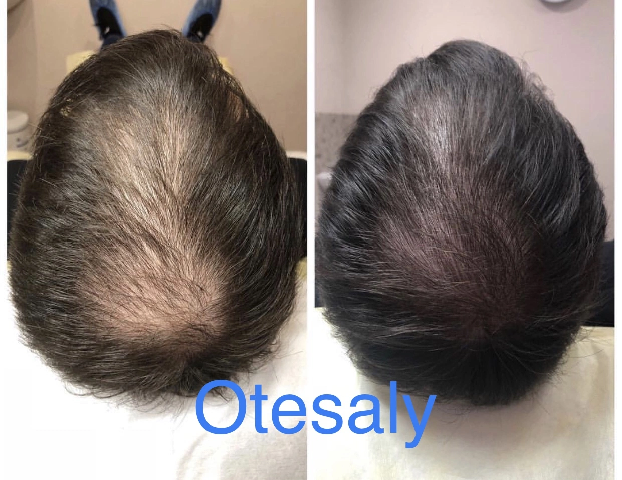 Hot Selling Top Quality Otesaly Anti Hair Loss Serum Scal Nourishing Mesotherapy Treatment Meso Solution