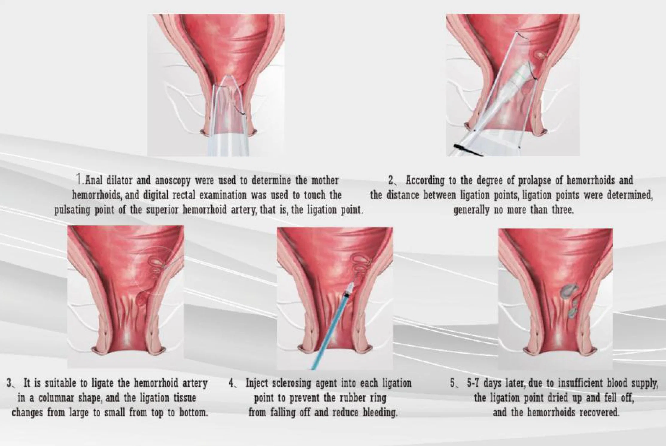 Équipement médical de coupe de chirurgie opératoire agrafeuse chirurgicale pour la chirurgie mini-invasive (endoscope)