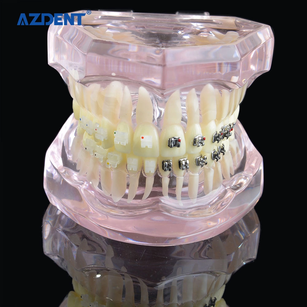 Dental Model of Teeth with Half Metal and Ceramic Bracket