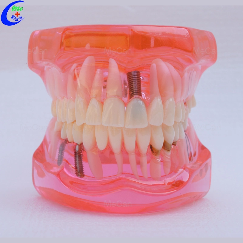 Human Teeth Model, Twice Permanent Teeth