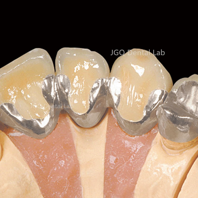 Dentures Teeth Metal Porcelain Ceramic Implant Pfm Crowns and Bridge From China Dental Lab