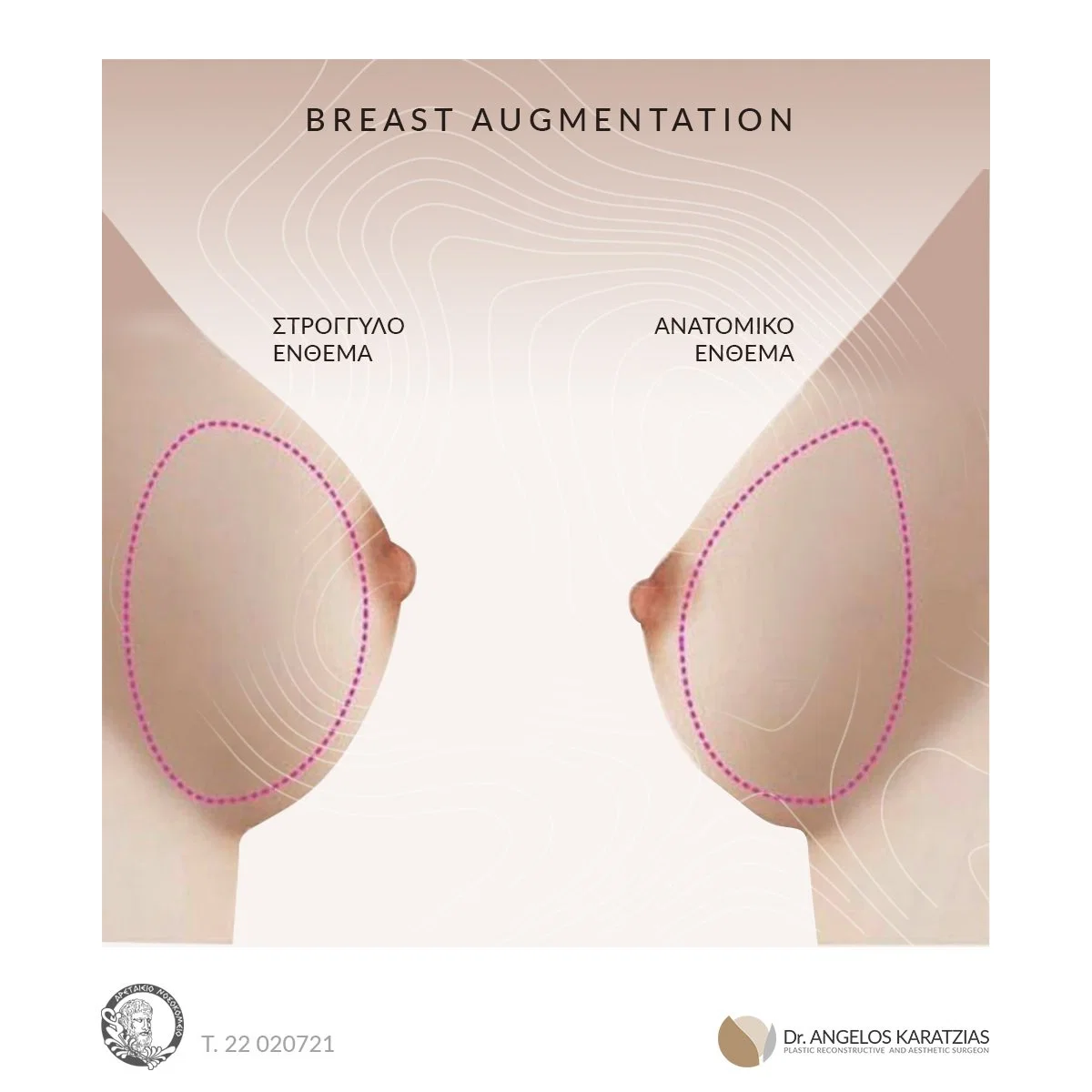 La chirurgie plastique origine tchèque avec l'implant mammaire Los Deline 100ml 100g Volumizing injectable implant breast fesse Aicd hyaluronique cutanée d'amélioration de bouchon de remplissage