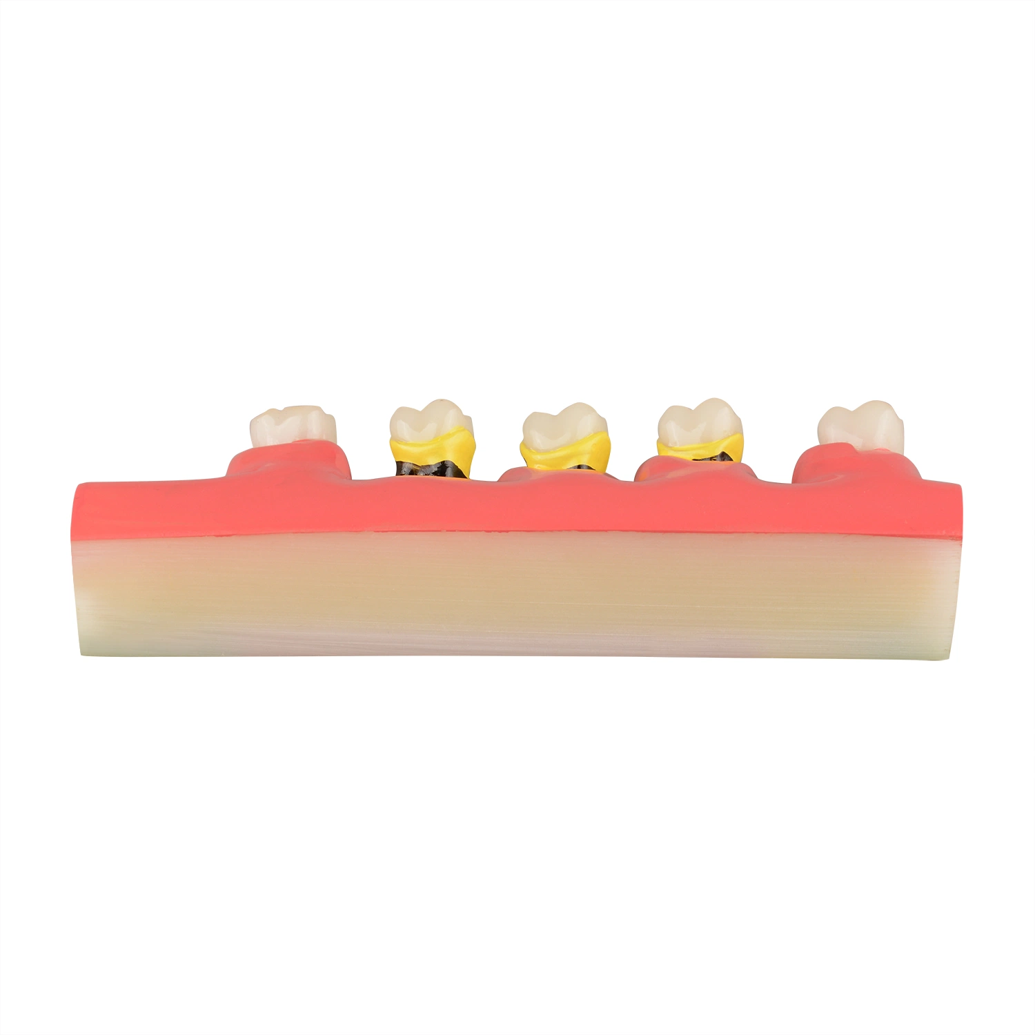 Dental Periodontal Disease Assort Model